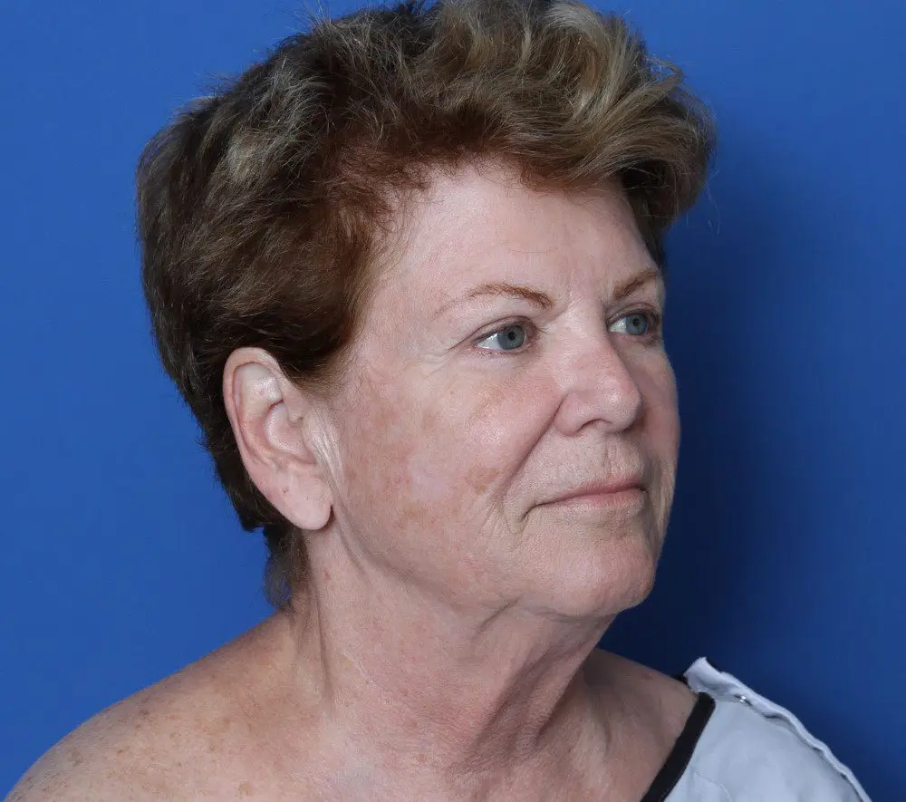 Facelift Patient Photo - Case 165 - before view-1