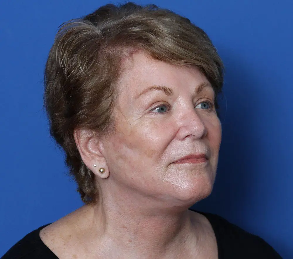 Facelift Patient Photo - Case 165 - after view-1