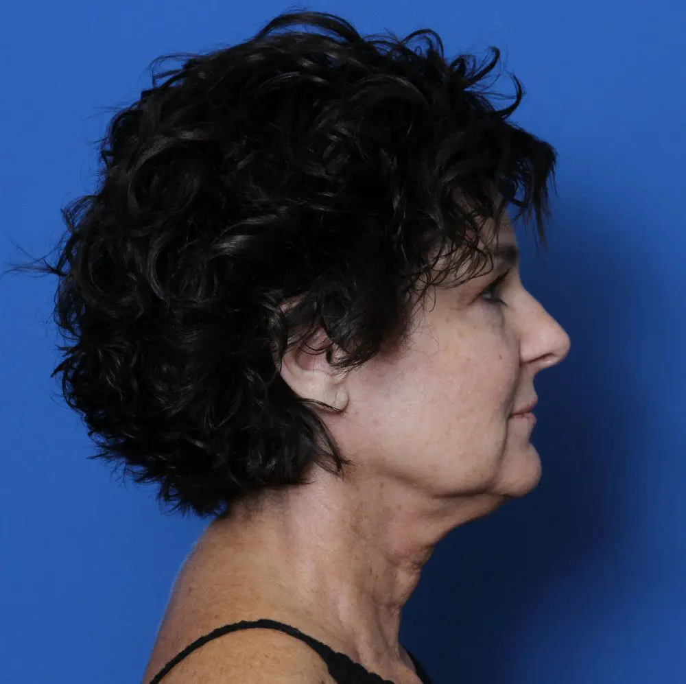 Facelift Patient Photo - Case 164 - before view-2