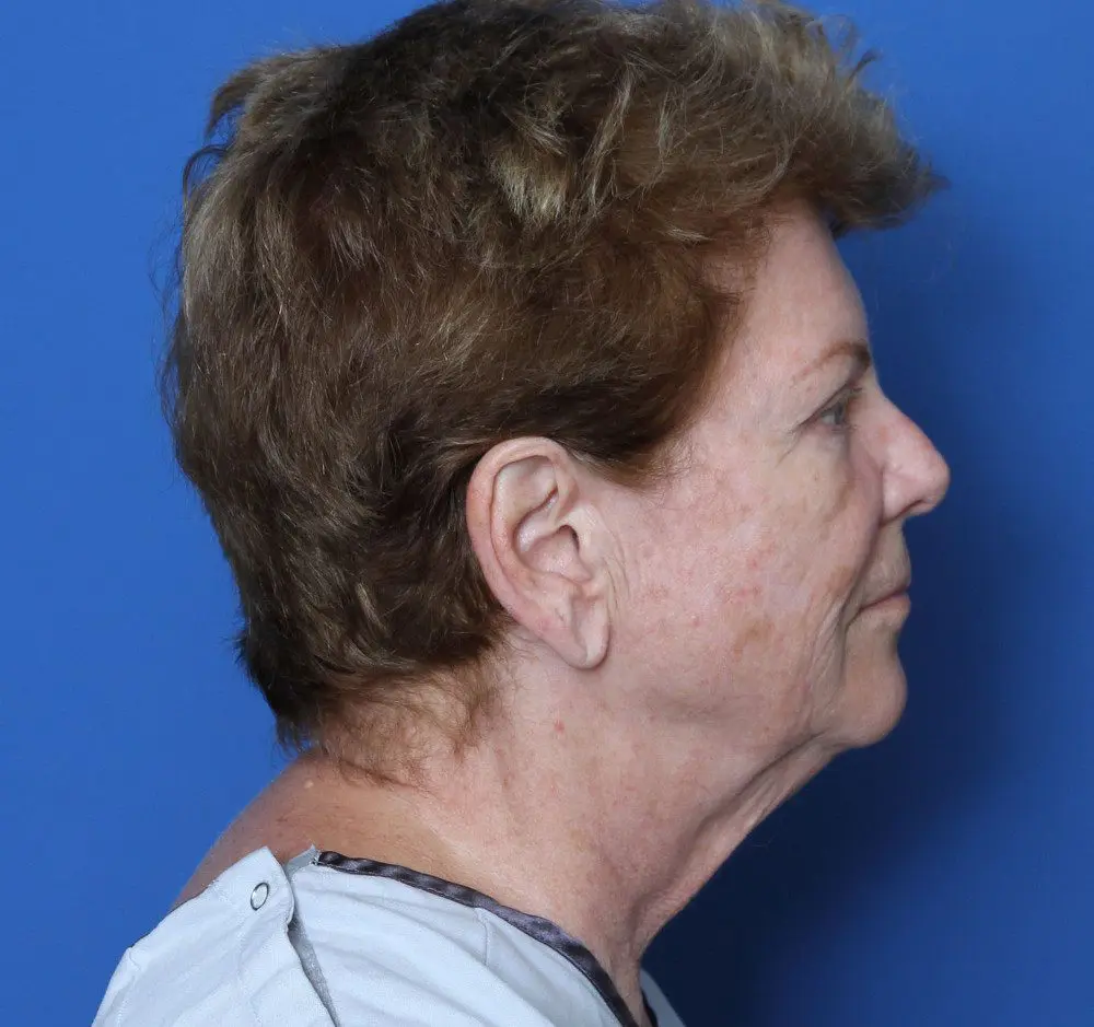 Brow Lift Patient Photo - Case 180 - before view-1