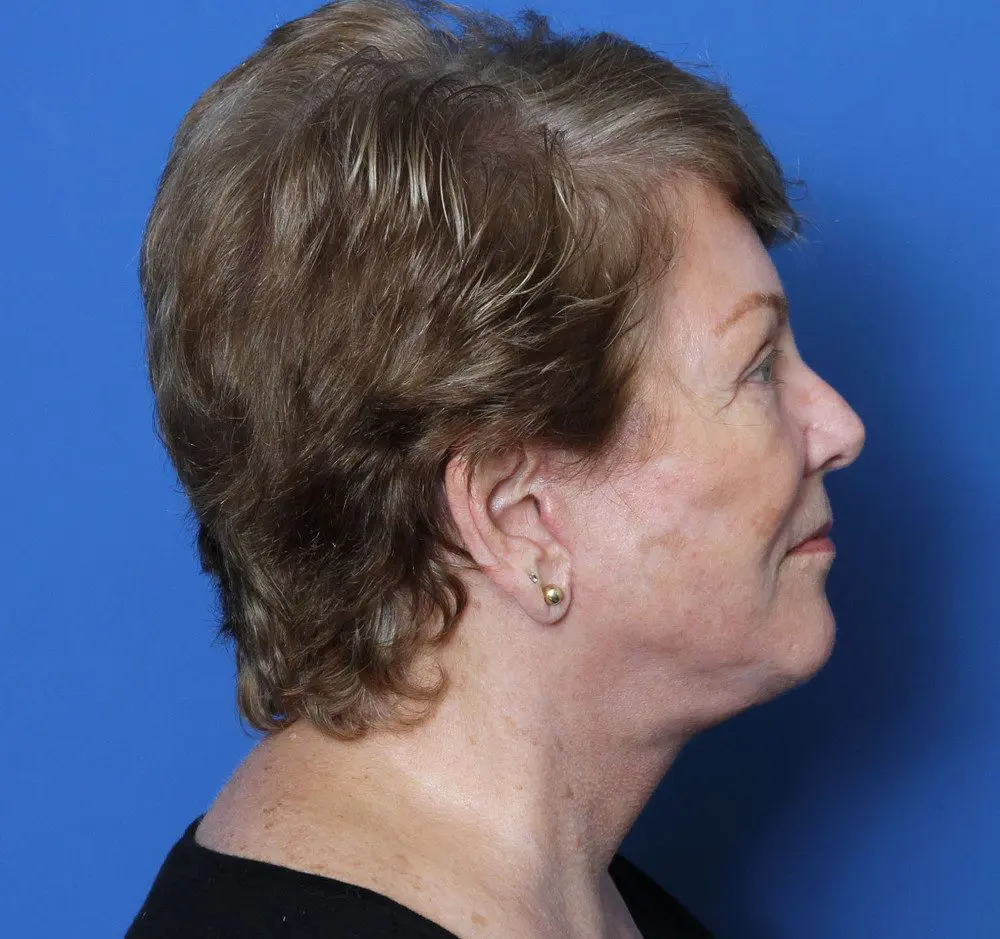 Brow Lift Patient Photo - Case 180 - after view-1