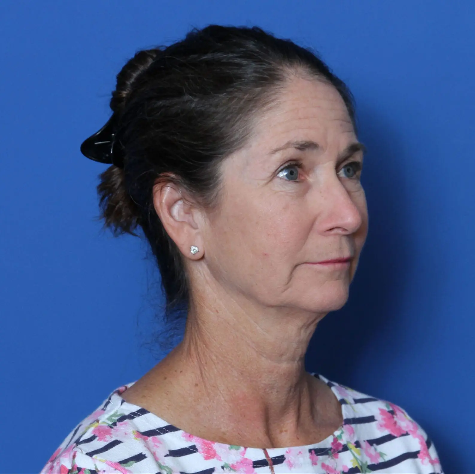 Facelift Patient Photo - Case MM0842 - before view-1