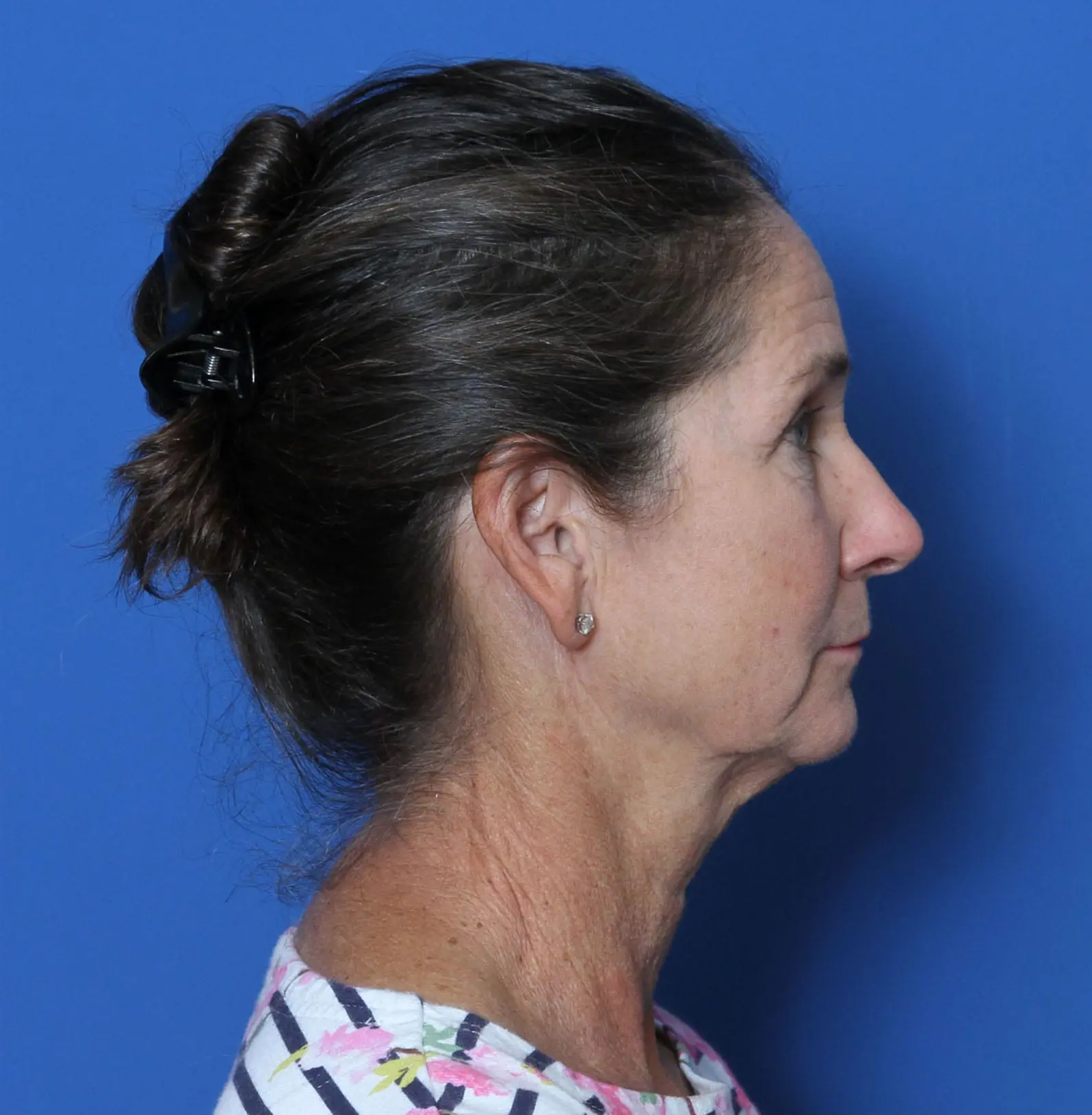 Facelift Patient Photo - Case MM0842 - before view-2