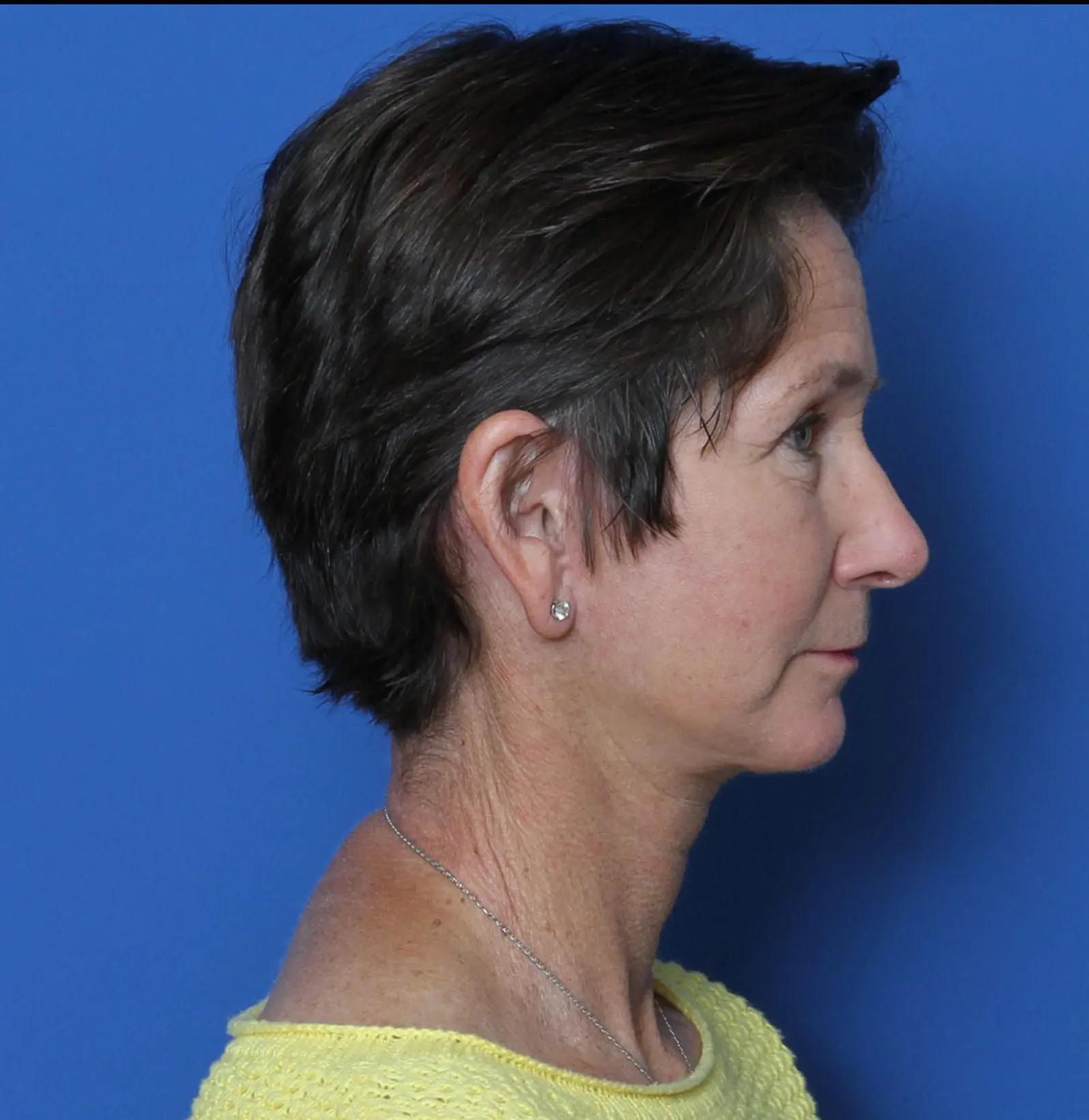 Facelift Patient Photo - Case MM0842 - after view-2