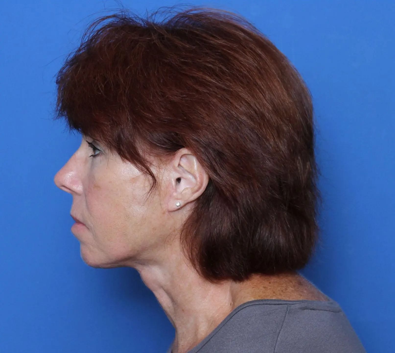 Facelift Patient Photo - Case MM5201 - after view-2