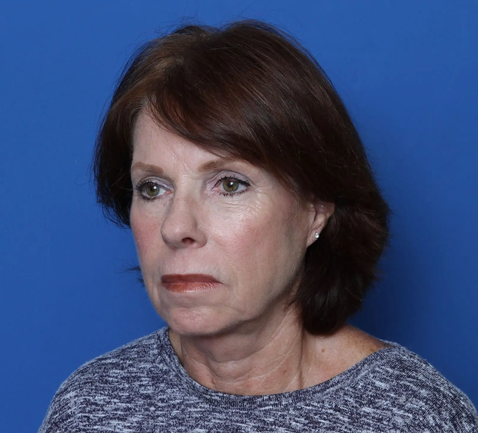 Facelift Patient Photo - Case MM5201 - before view-1
