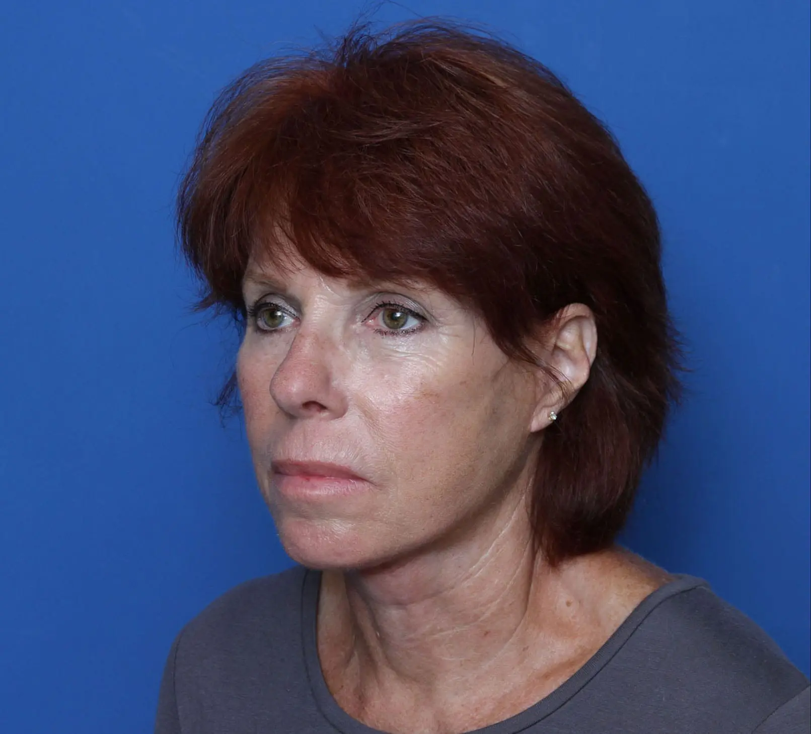 Facelift Patient Photo - Case MM5201 - after view-1