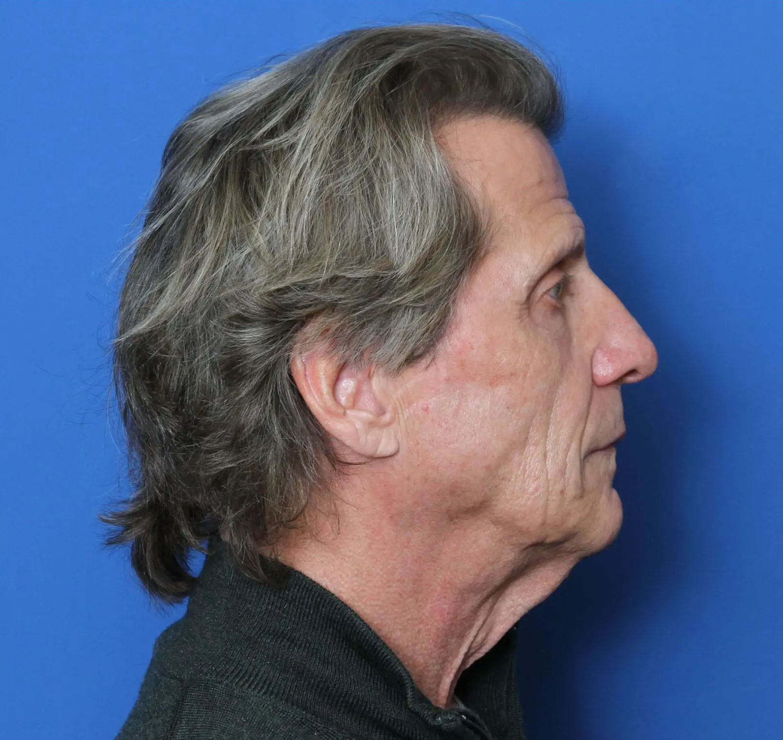 Facelift Patient Photo - Case MM1025 - before view-2