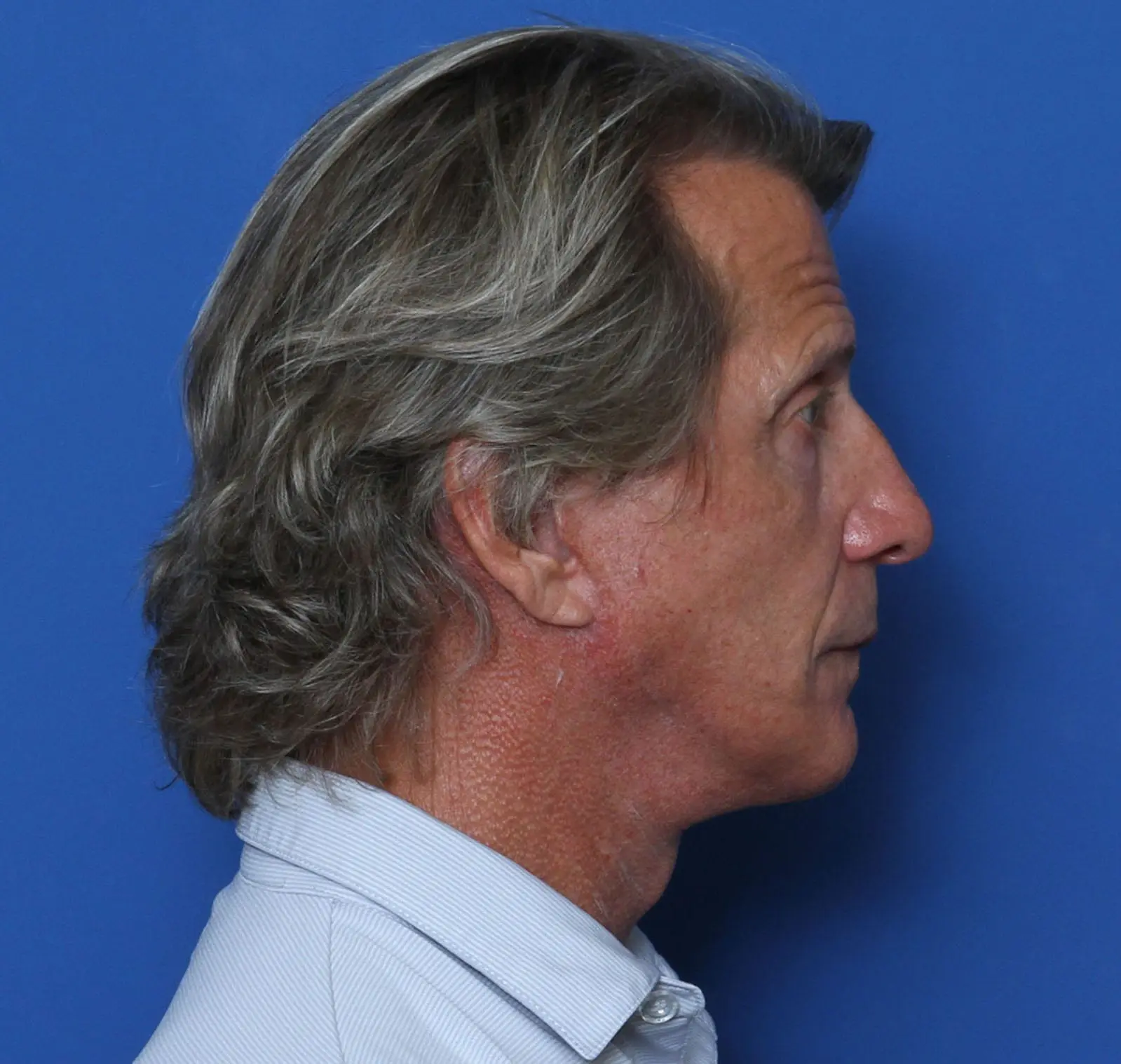 Facelift Patient Photo - Case MM1025 - after view-2