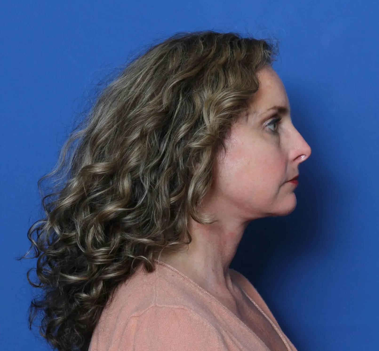 Facelift Patient Photo - Case MM4533 - after view-2
