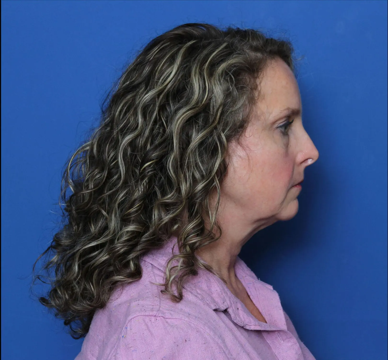 Facelift Patient Photo - Case MM4533 - before view-2