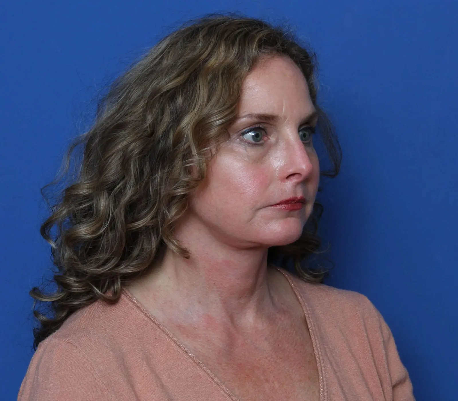 Facelift Patient Photo - Case MM4533 - after view-1