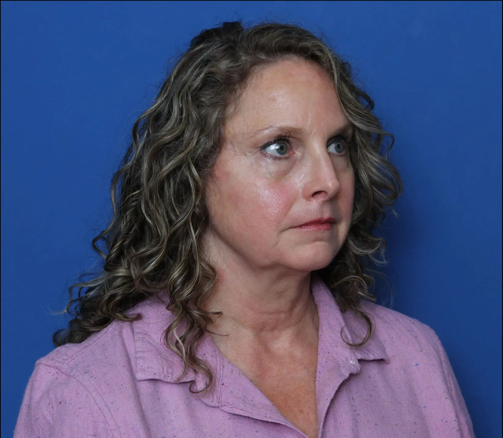 Facelift Patient Photo - Case MM4533 - before view-1