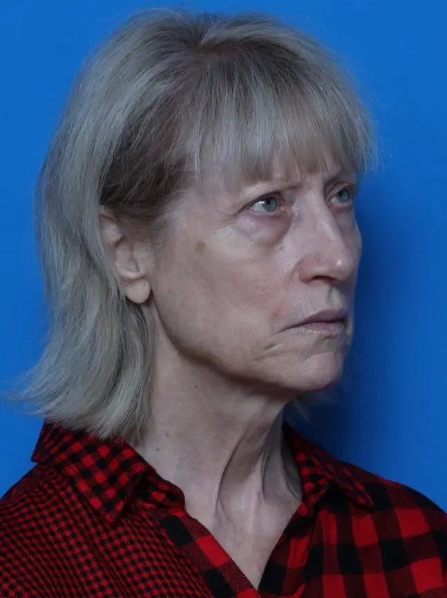 Brow Lift Patient Photo - Case 8567 - before view-1