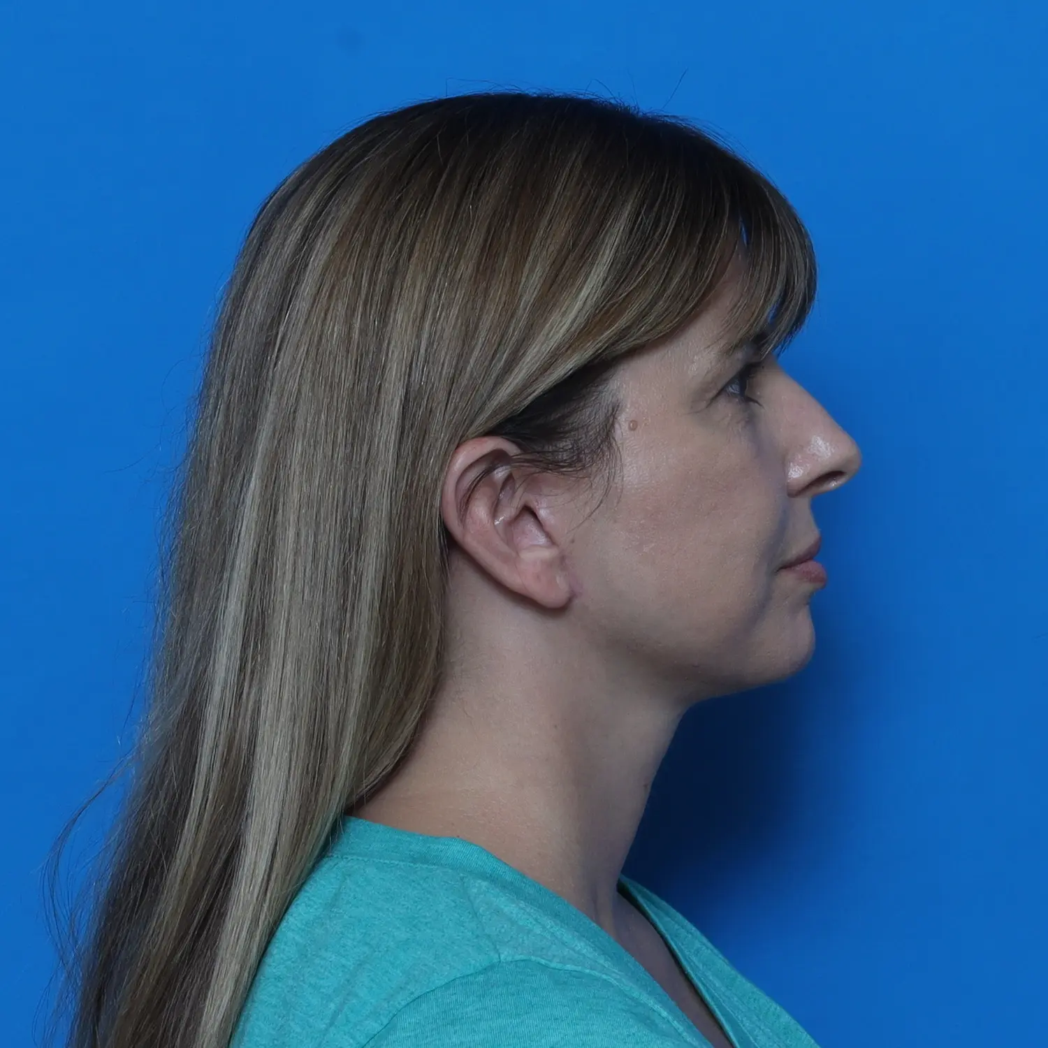 Facelift Patient Photo - Case 10768 - after view-3