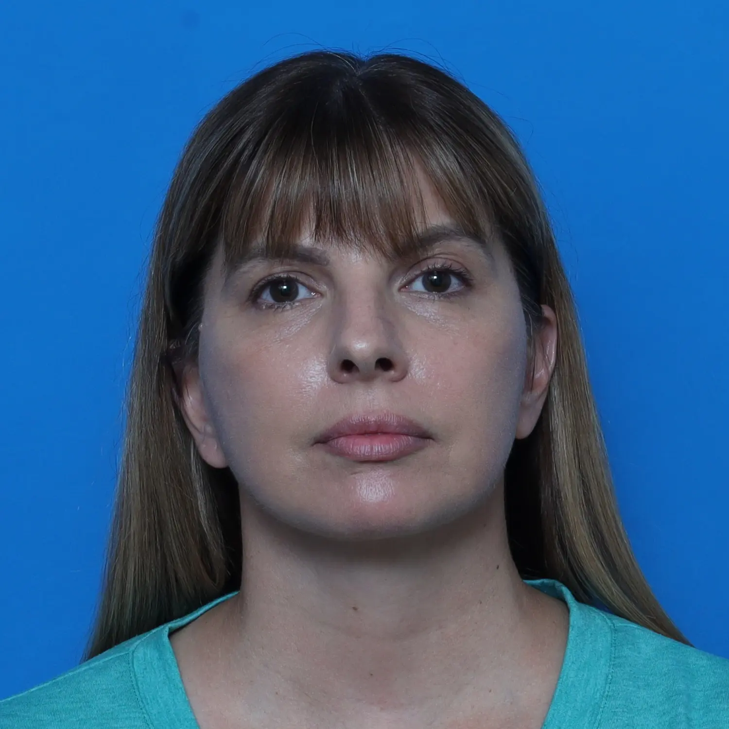 Facelift Patient Photo - Case 10768 - after view