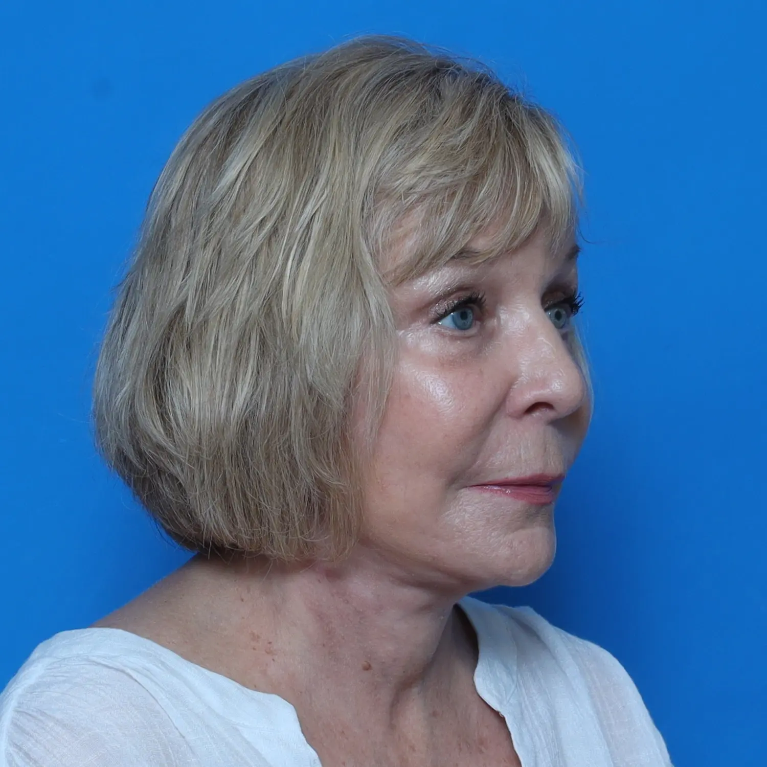 Facelift Patient Photo - Case 10778 - after view-1