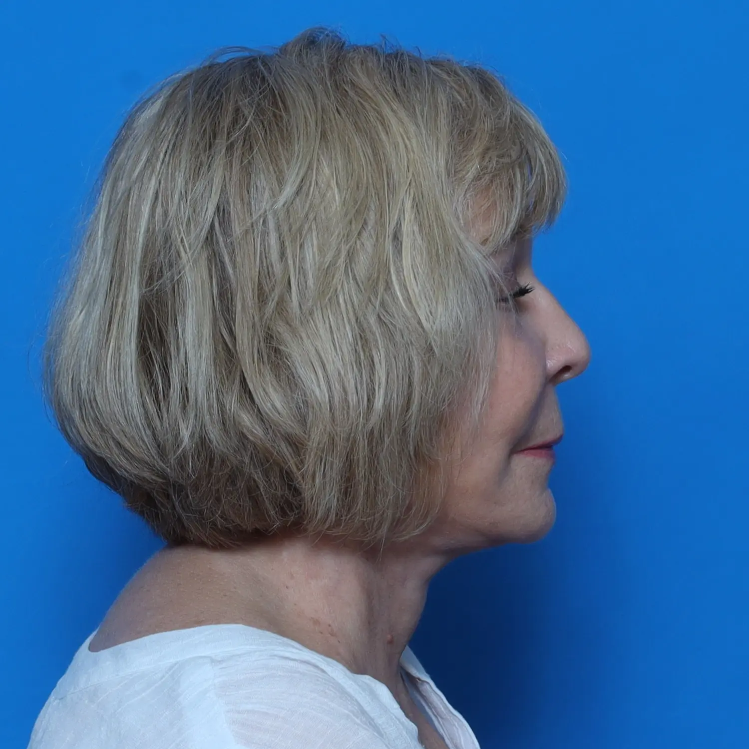Facelift Patient Photo - Case 10778 - after view-2