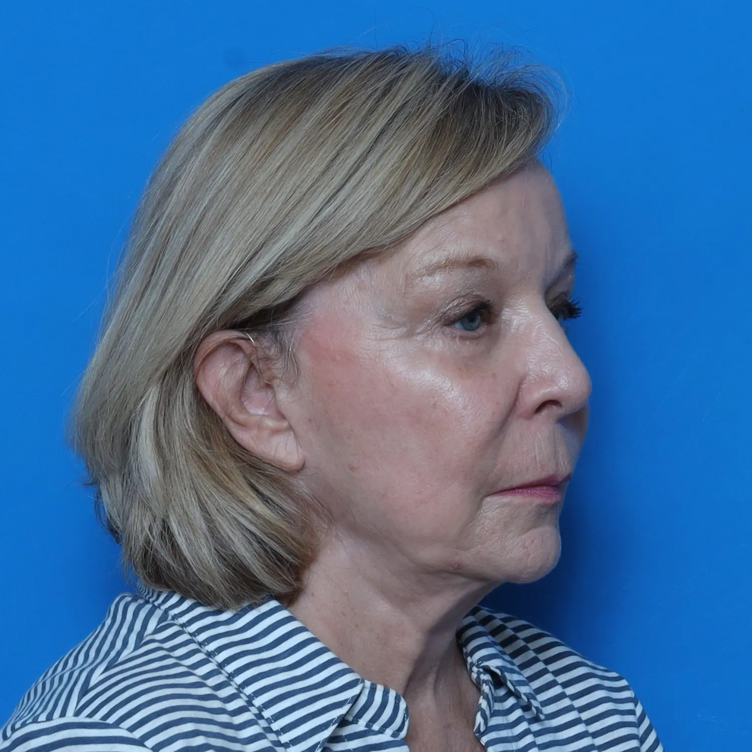 Facelift Patient Photo - Case 10778 - before view-1