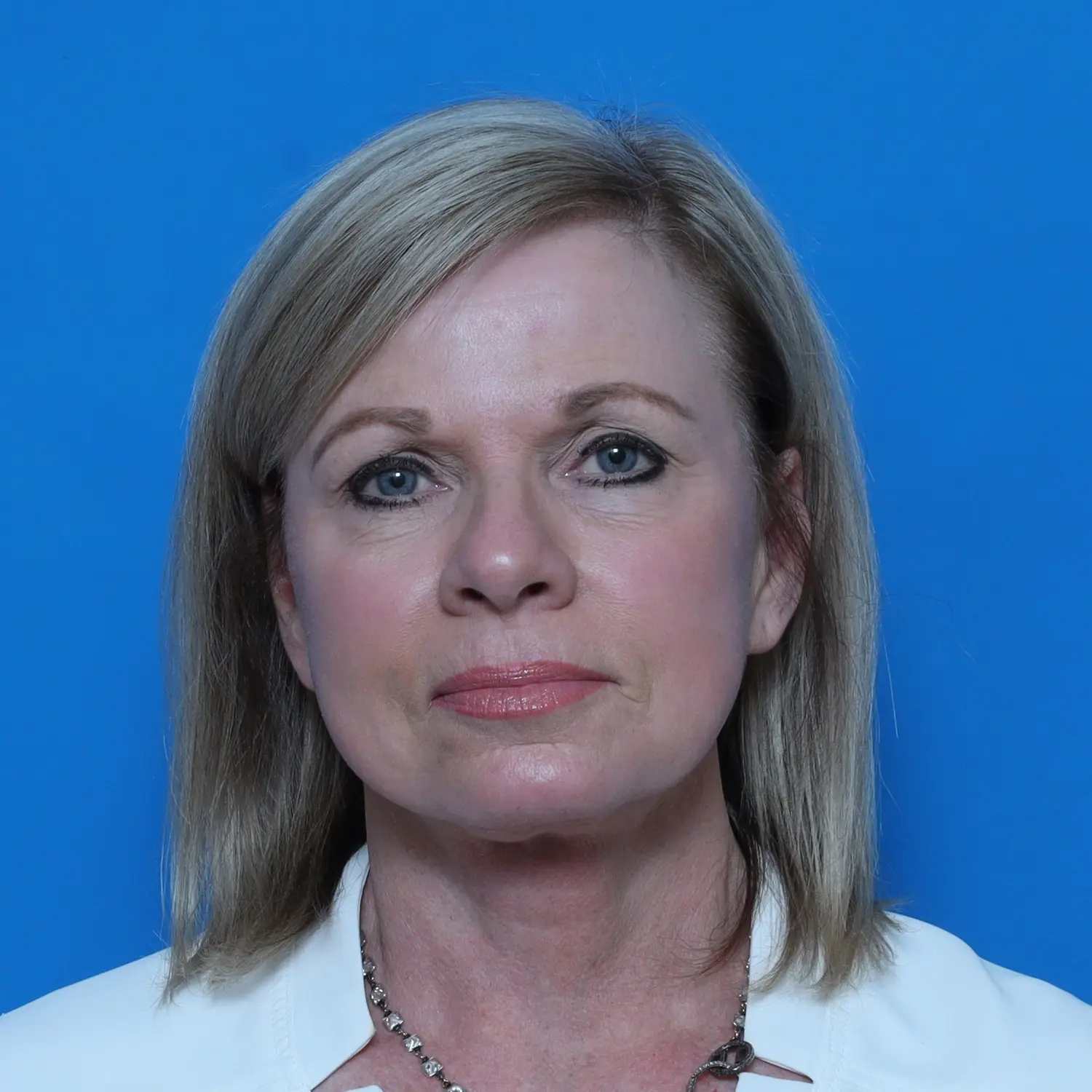 Facelift - Case 10826 - After