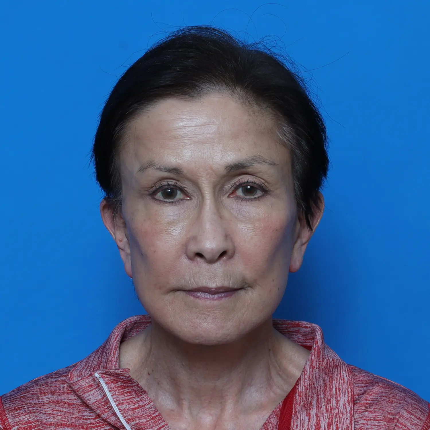 Brow Lift Patient Photo - Case 10836 - after view