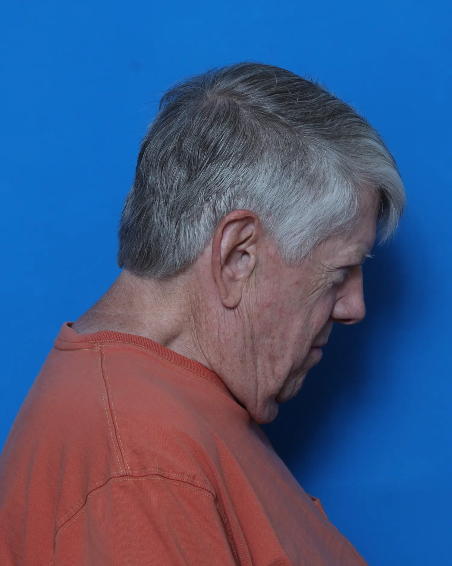 Facelift Patient Photo - Case 10991 - before view-1