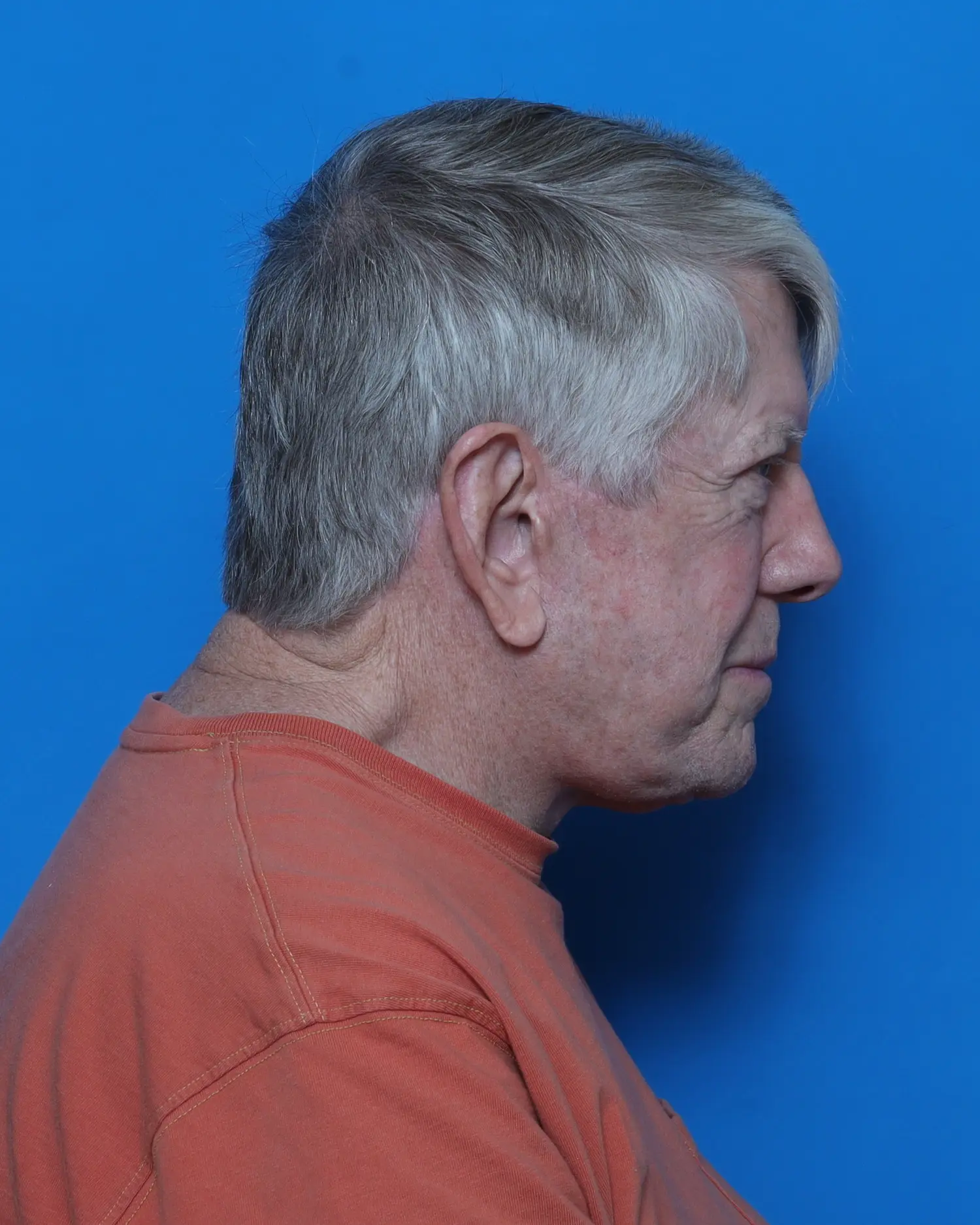 Facelift Patient Photo - Case 10991 - after view-1