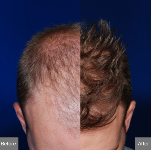 NeoGraft results
