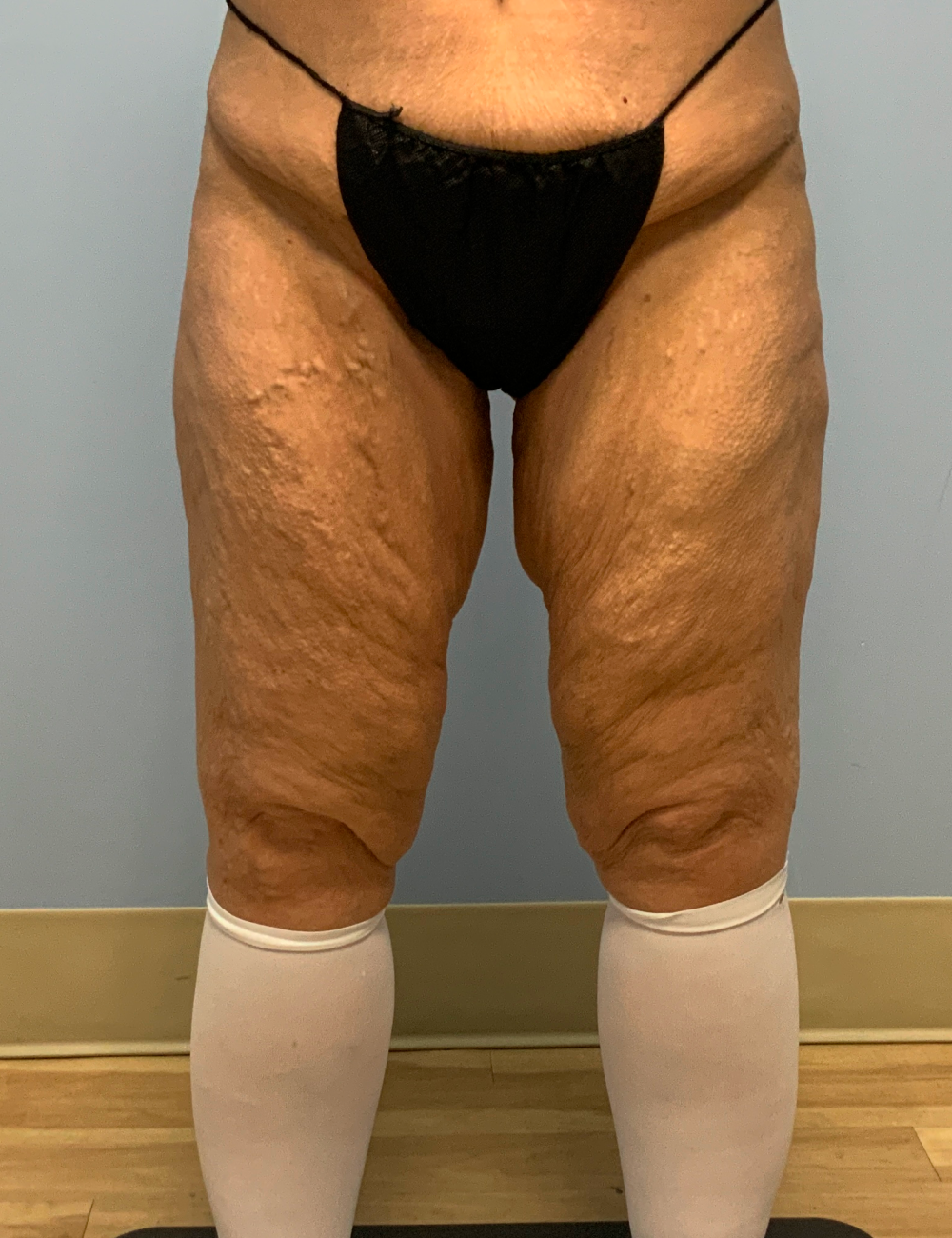 After Weight Loss - Case 12248 - Before