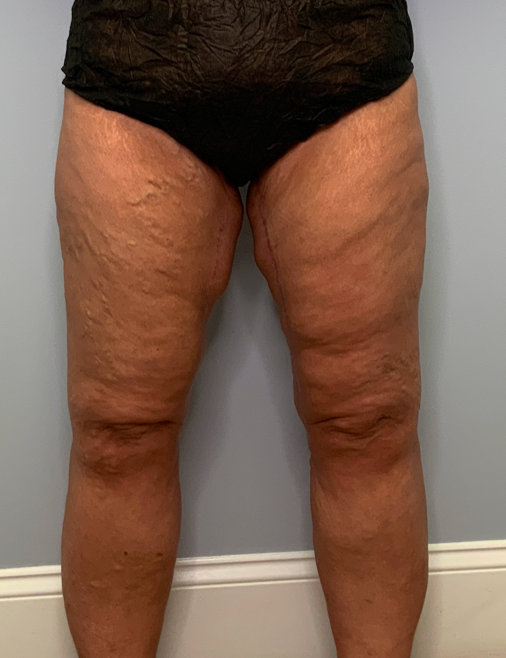 After Weight Loss - Case 12248 - After