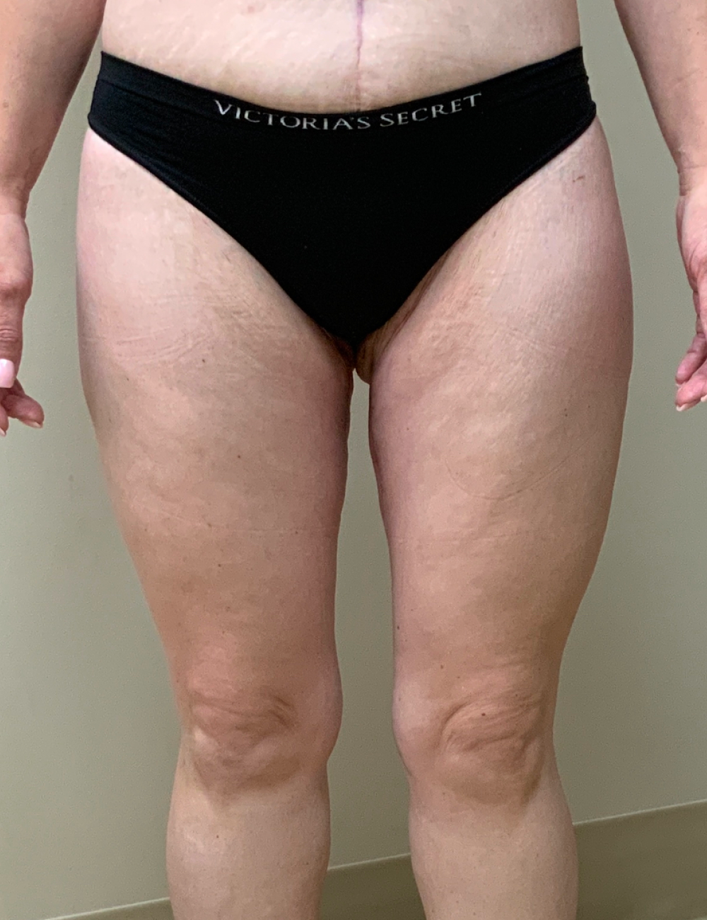 After Weight Loss - Case 12262 - After