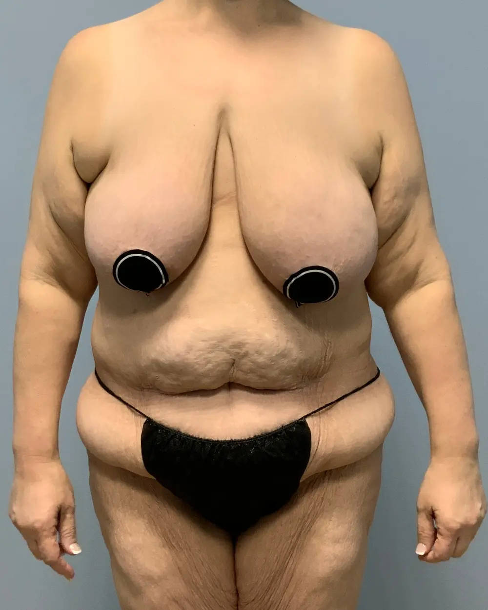 After Weight Loss - Case 13355 - Before