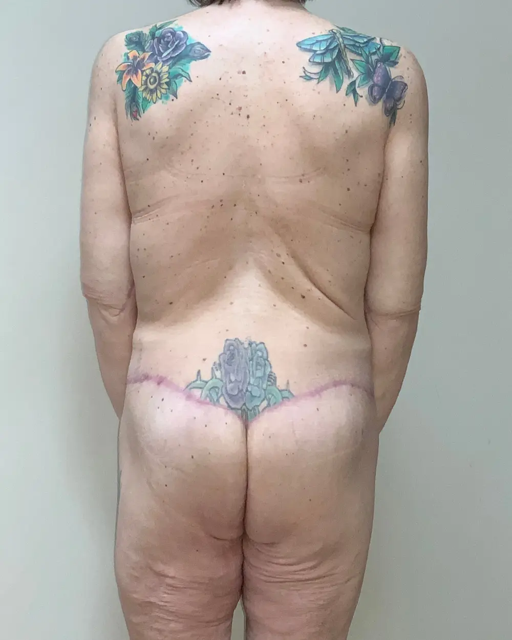 After Weight Loss Patient Photo - Case 13253 - after view