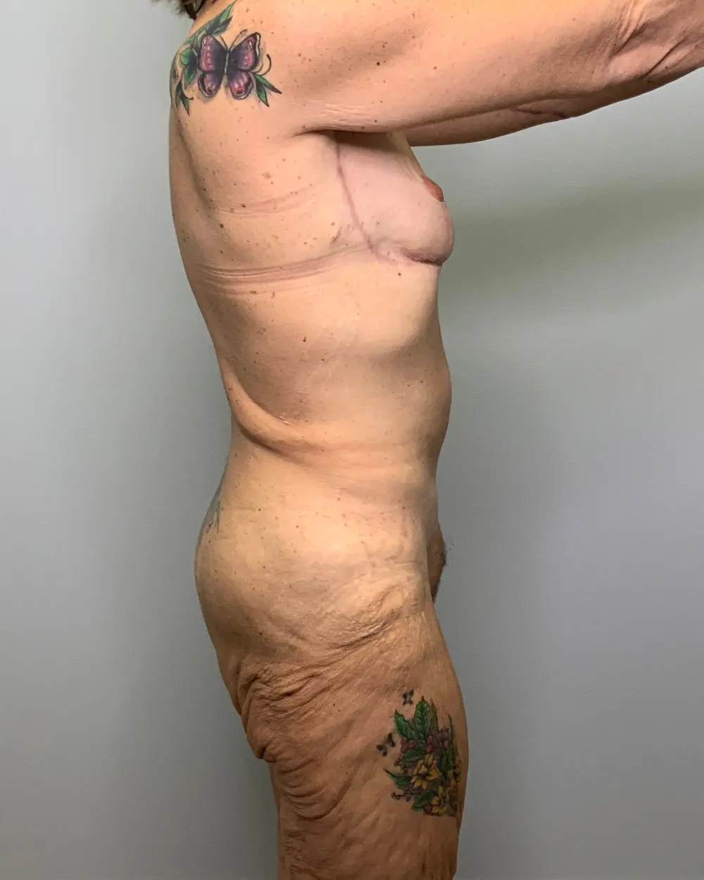 After Weight Loss Patient Photo - Case 13253 - before view-2