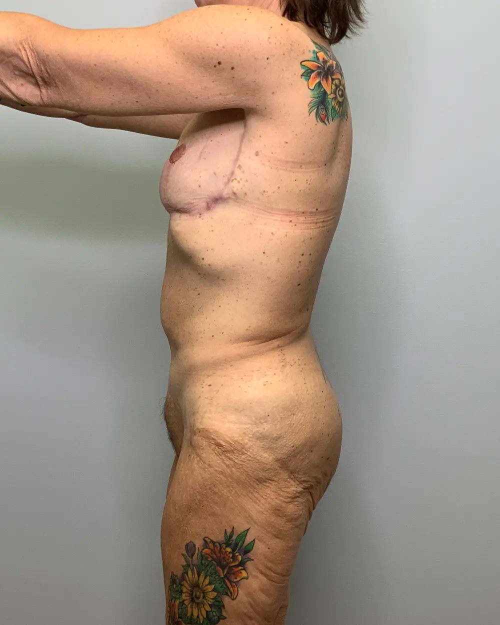 After Weight Loss Patient Photo - Case 13253 - before view-1