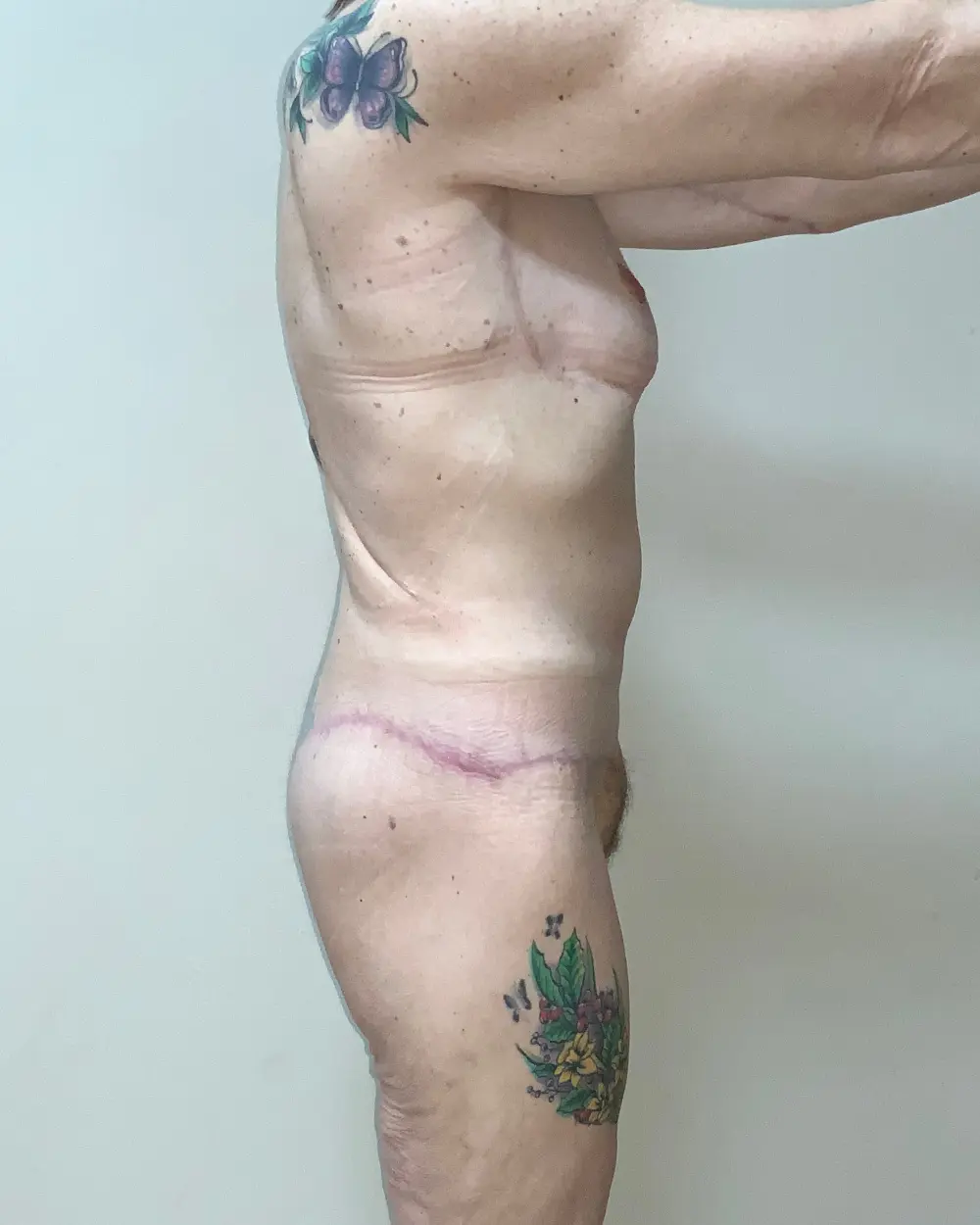 After Weight Loss Patient Photo - Case 13253 - after view-2