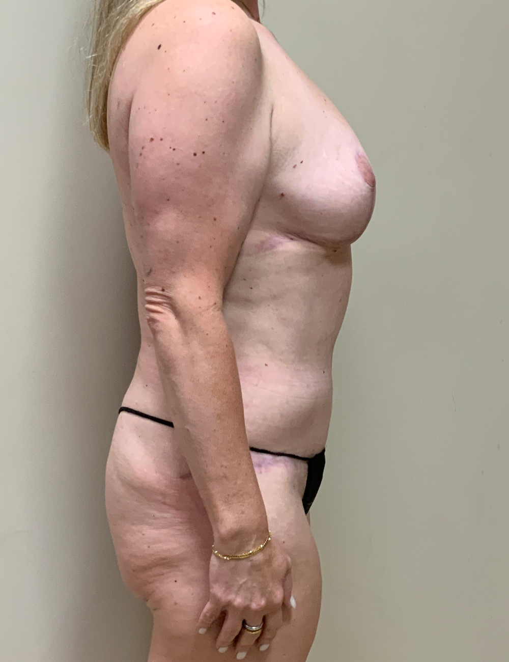 Breast Lift Patient Photo - Case 13317 - after view-1