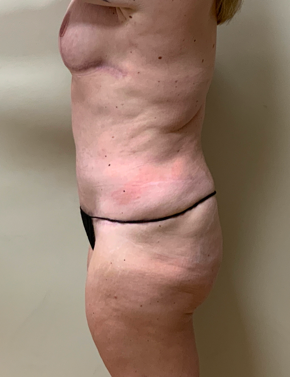 Breast Lift Patient Photo - Case 13317 - after view-5