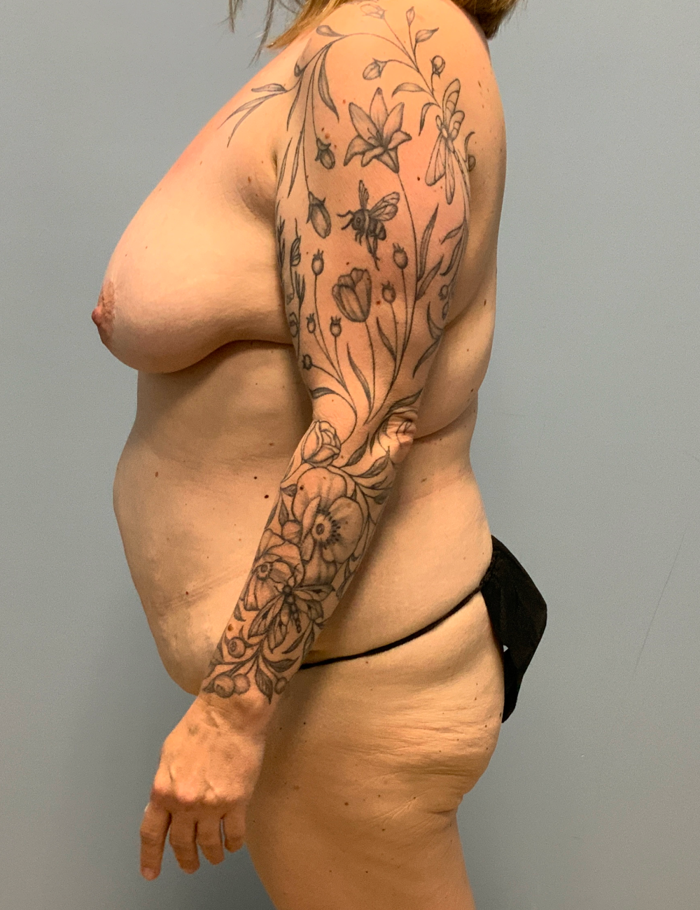Breast Lift Patient Photo - Case 13317 - before view-4