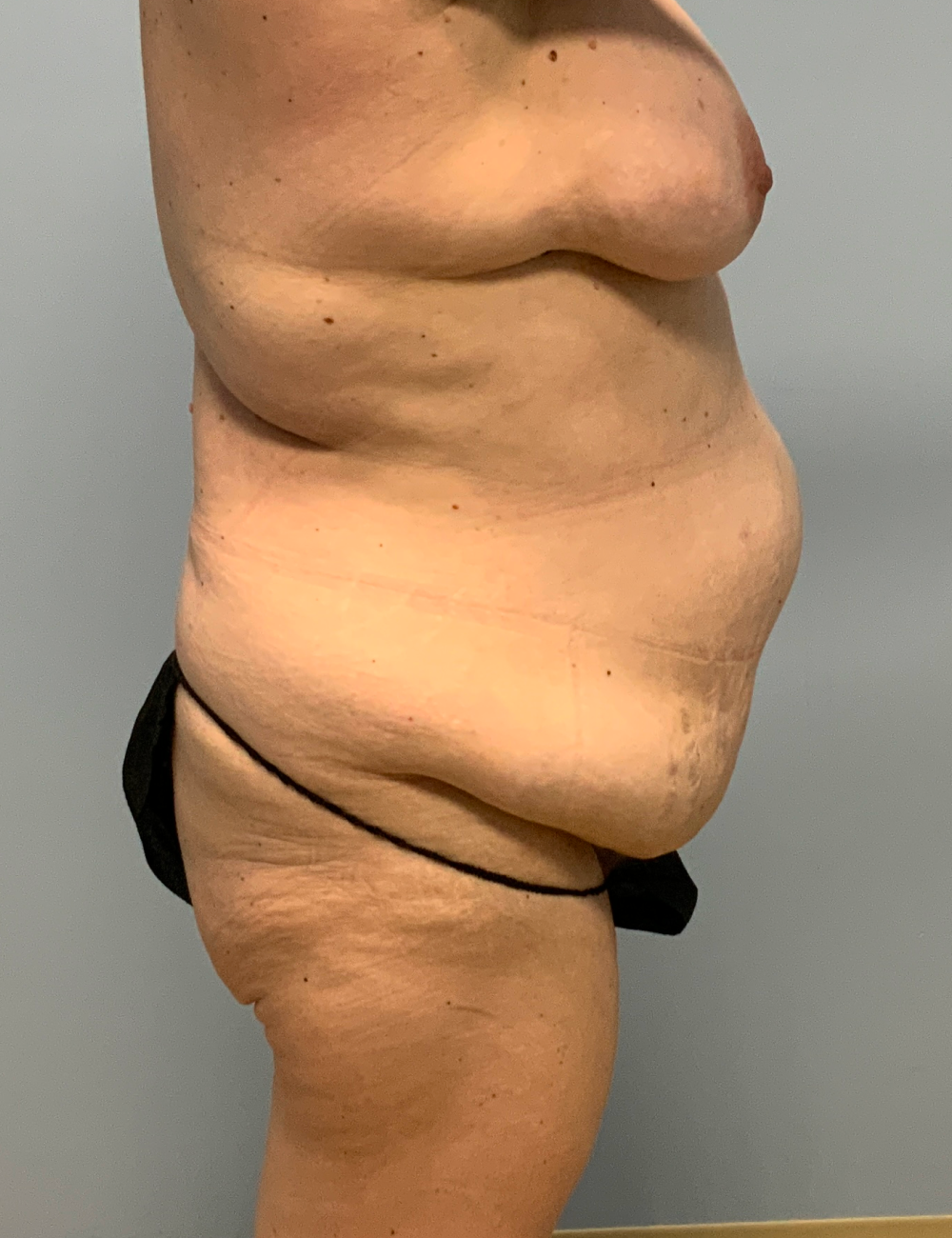 Breast Lift Patient Photo - Case 13317 - before view-2