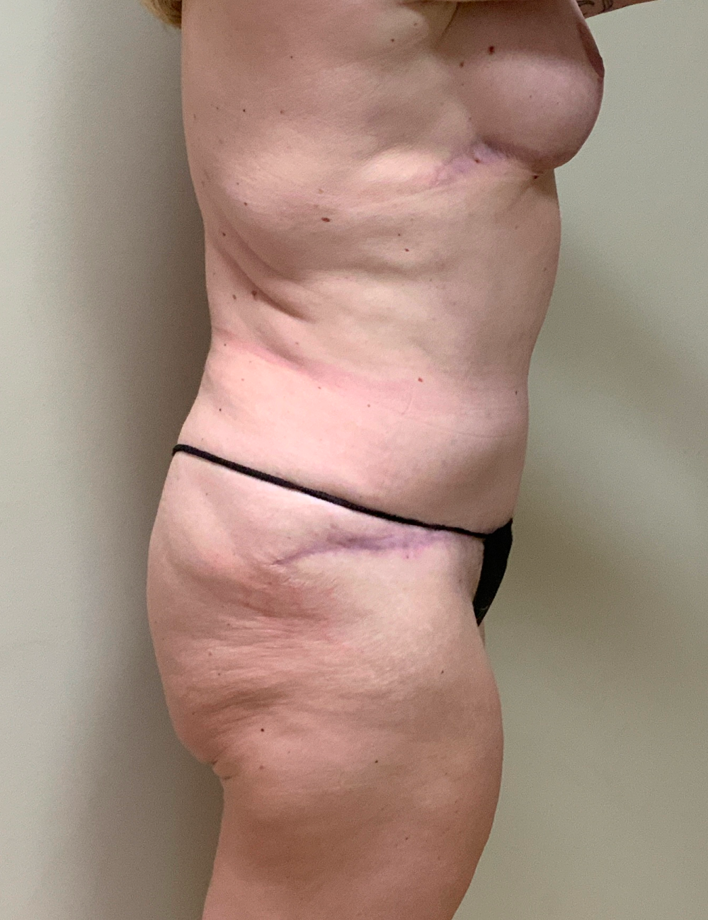 Breast Lift Patient Photo - Case 13317 - after view-2