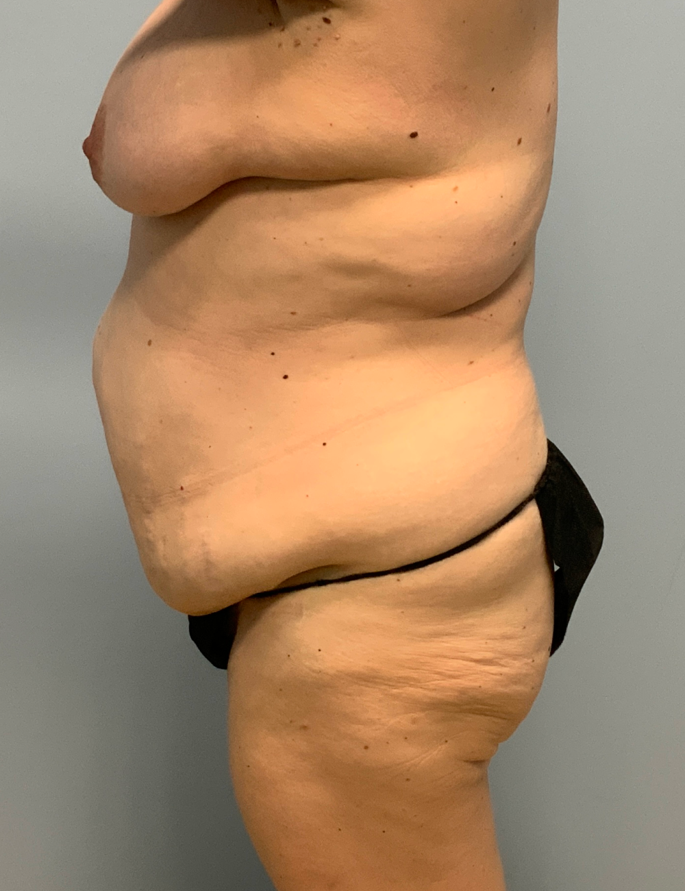 Breast Lift Patient Photo - Case 13317 - before view-5