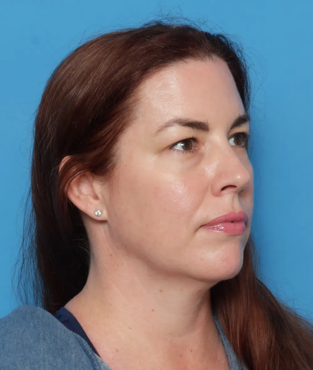Facelift Patient Photo - Case 13615 - before view-1