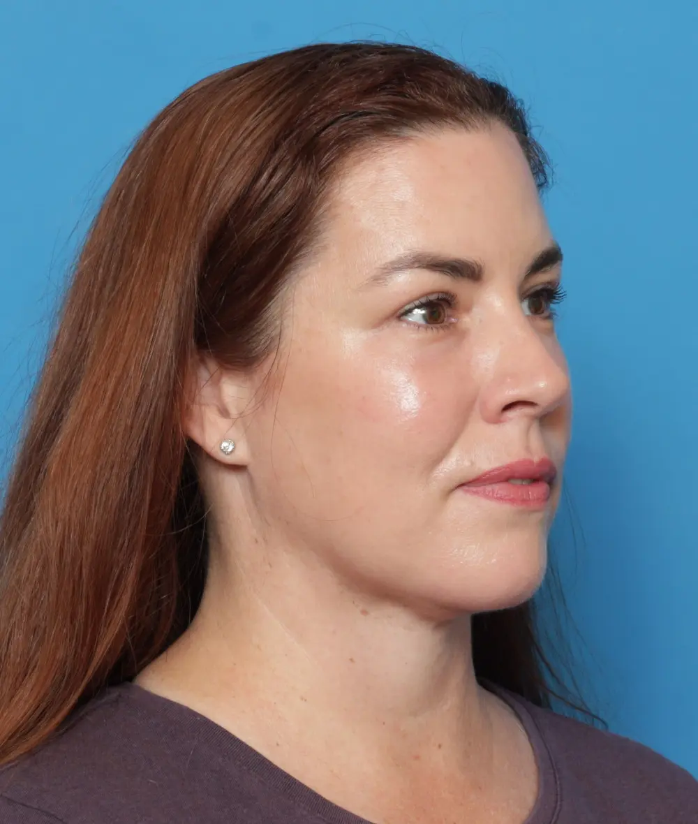 Facelift Patient Photo - Case 13615 - after view-1