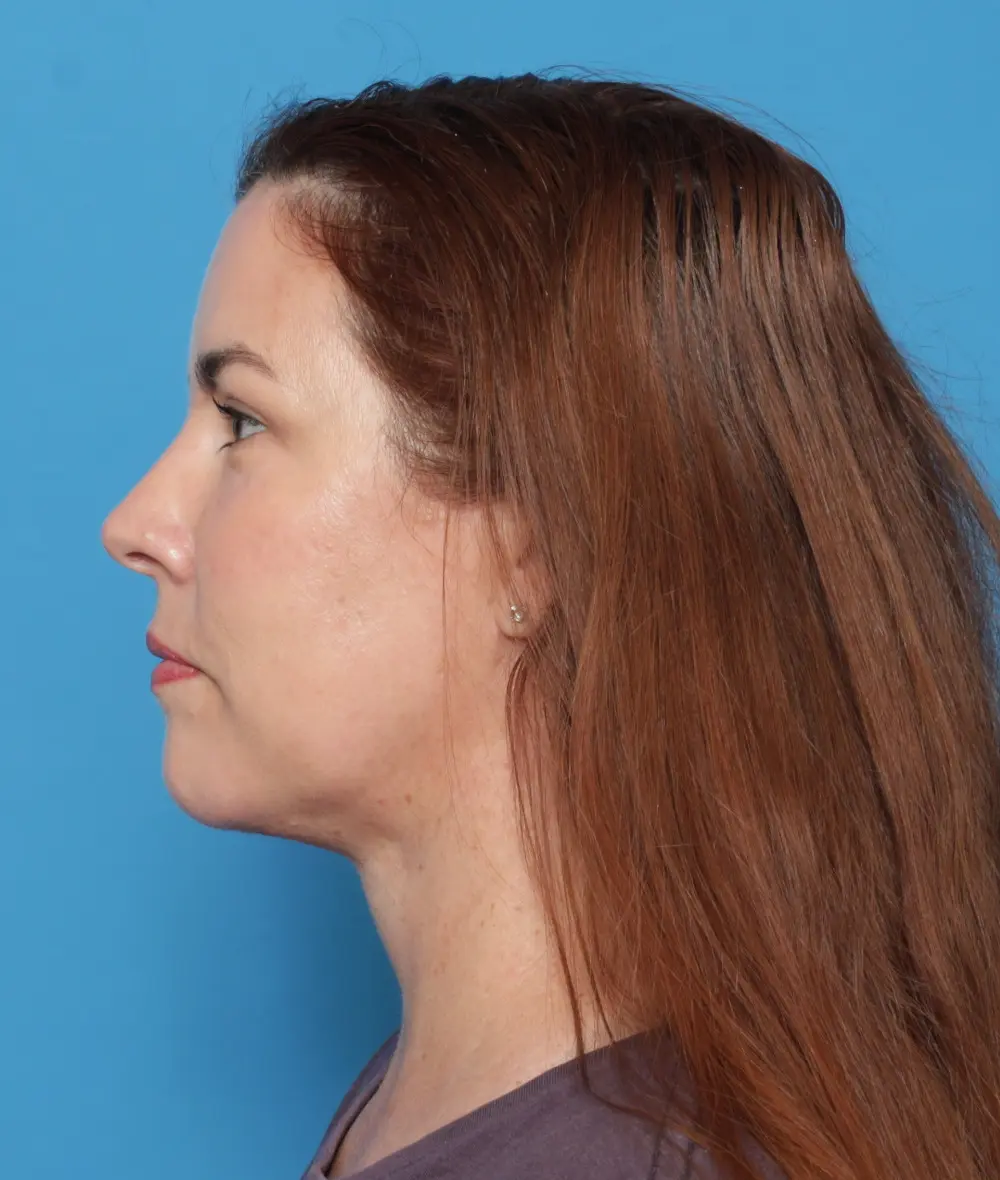 Facelift Patient Photo - Case 13615 - after view-4