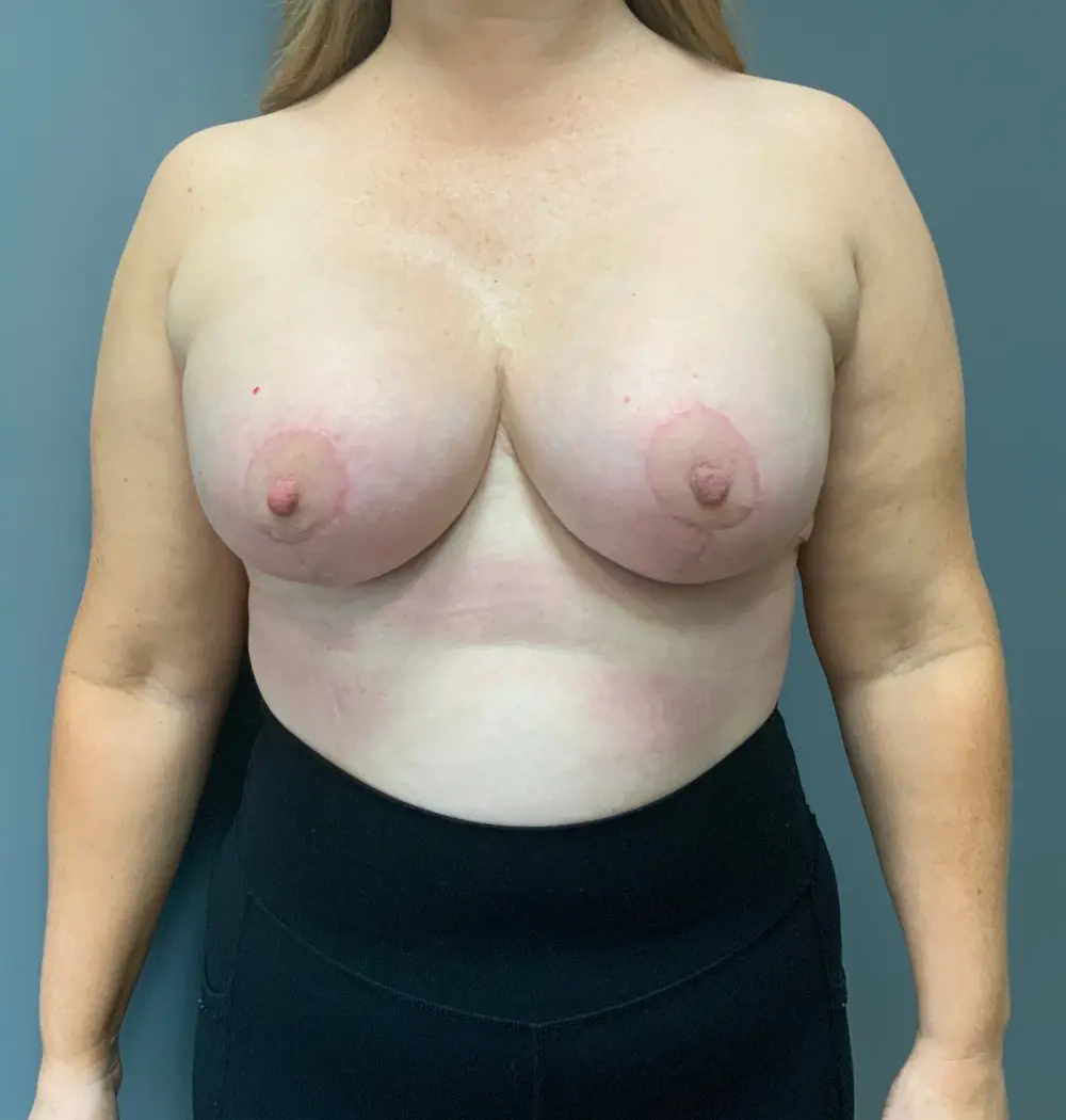 Breast Lift Patient Photo - Case 13859 - after view