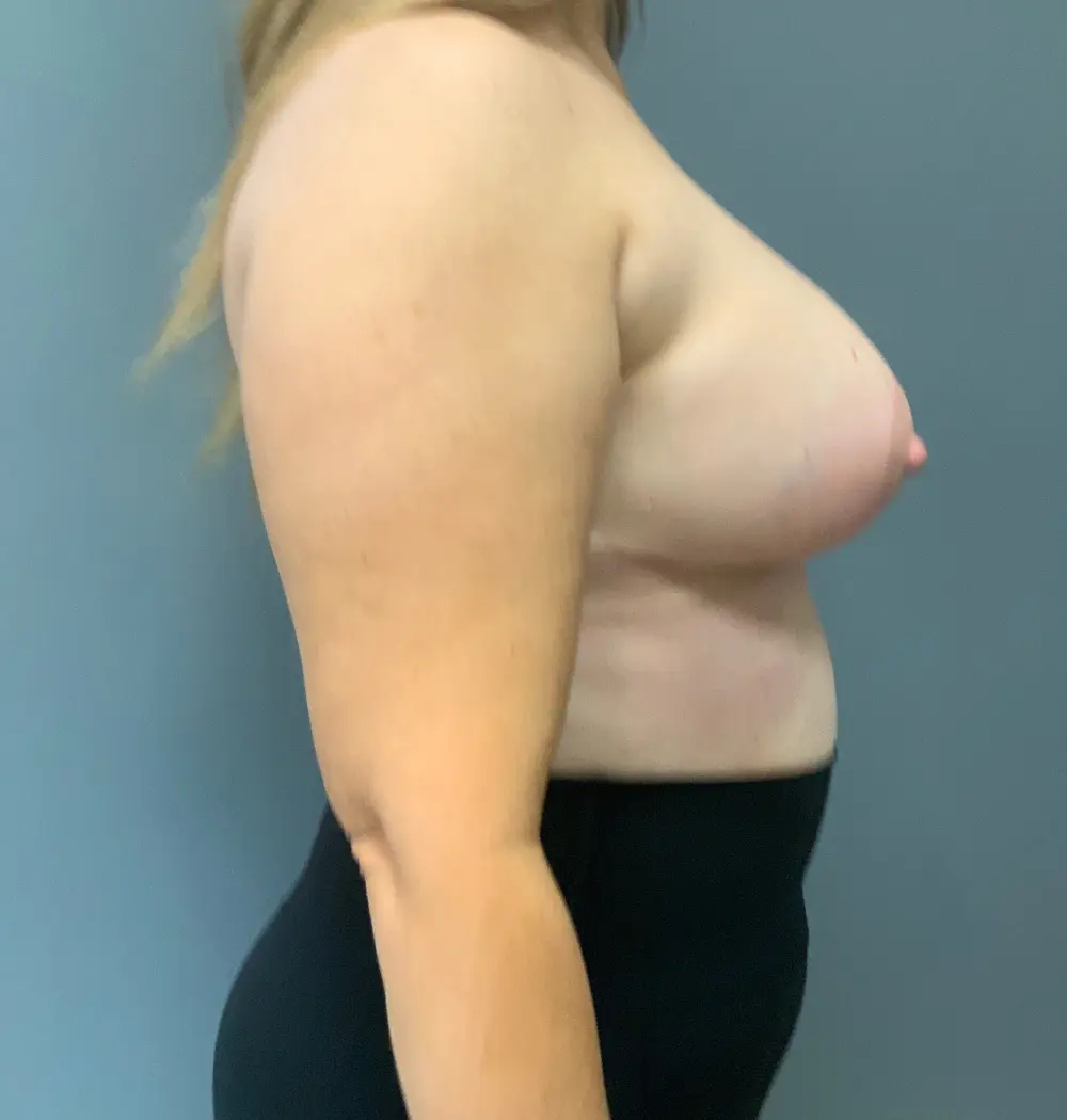 Breast Lift Patient Photo - Case 13859 - after view-4