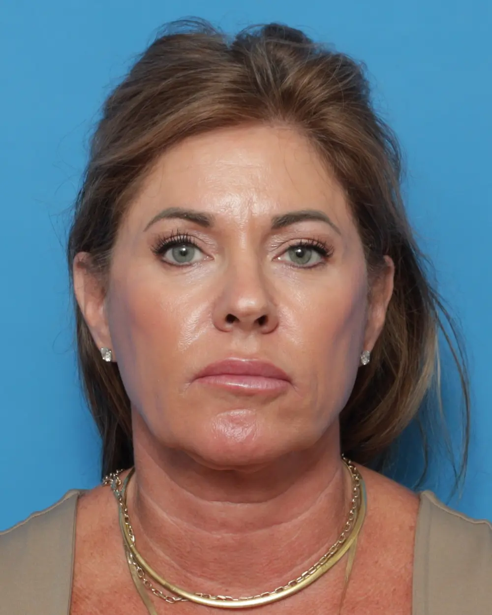 Facelift - Case 13891 - Before