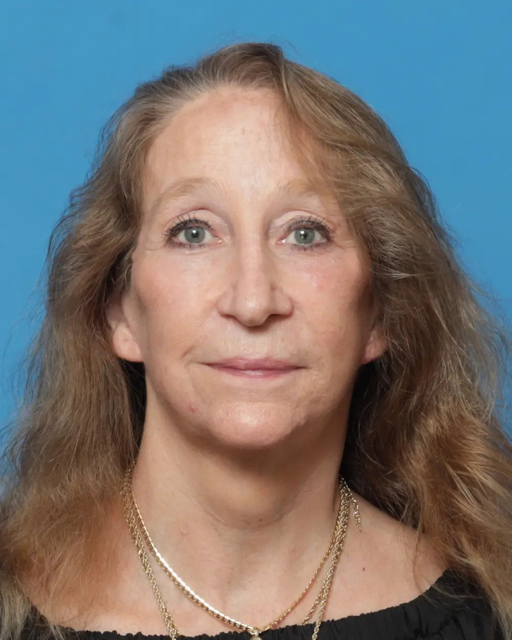 Eyelid Surgery Patient Photo - Case 13927 - after view