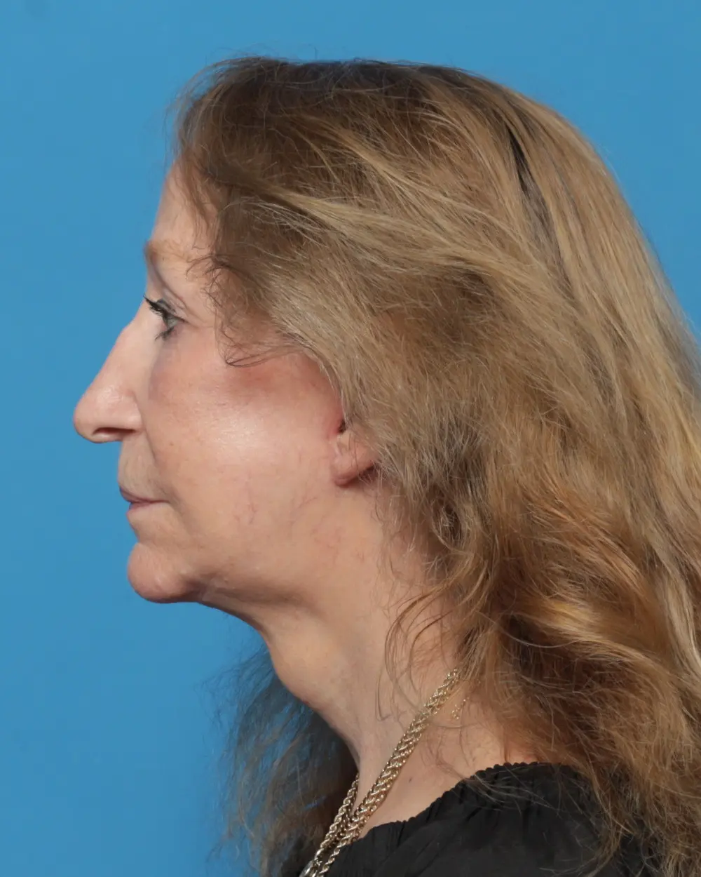 Eyelid Surgery Patient Photo - Case 13927 - after view-4